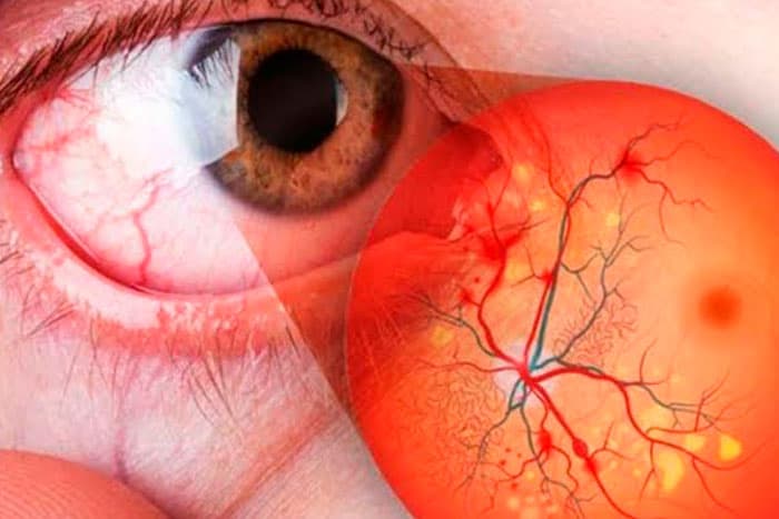 Artículo sobre retinopatía diabética